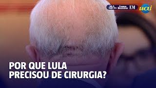 Hemorragia intracraniana o que é e por que Lula foi operado [upl. by Nilyam]