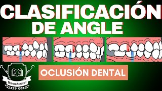 CLASIFICACIÓN DE LAS MALOCLUSIONES  CLASIFICACIÓN DE ANGLE  oclusión dental [upl. by Cheatham]