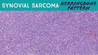 Synovial sarcoma monophasic with classic quotherringbonequot pattern soft tissue pathology [upl. by Esorrebma]