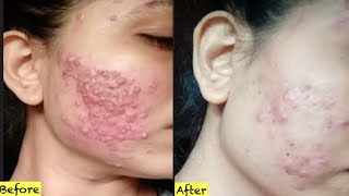 Acne treatment at home 3 days Acne Removal Challenge [upl. by Airlie]