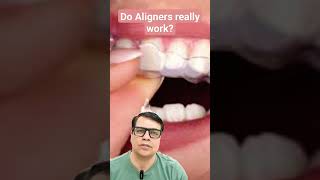 Do Aligners Really work youtubeshorts shortvideo shorts short teeth braces aligners [upl. by Nnylannej150]