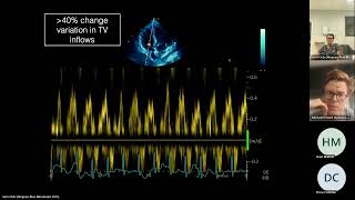 Pericardial Disease [upl. by Torhert]