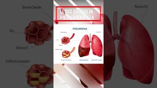 Lung sound in Pneumonia [upl. by Akimaj]