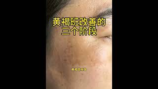 Laser chloasma treatment process [upl. by Mitchael948]