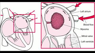 Left atrial myxoma [upl. by Ellehcam]