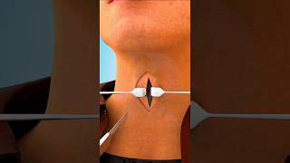 Tracheostomy Surgery Tracheostomy procedure 3D animationTracheostomy Tubeviralshortsdrsadiayt [upl. by Einhapets]