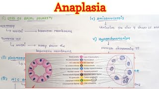 Anaplasia  Neoplasia  General Pathology [upl. by Alra]