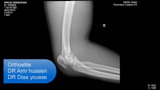 OLECRANON FRACTURE [upl. by Corsiglia]