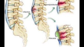 Infectious Spondylodiscitis [upl. by Sigsmond]