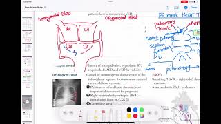 Truncus arteriosus congenitalheartdefect cardiology 52  First Aid USMLE Step 1 in UrduHindi [upl. by Ettezel24]