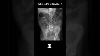 Dilated small amp large bowel Abdominal XrayAbnormalities 69 radiologychannel007 [upl. by Menis478]