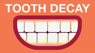 What causes tooth decay [upl. by Mendoza]