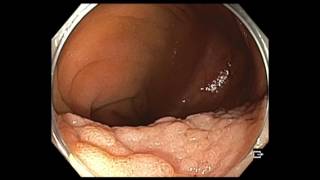 Colonoscopy IC valve and cecum flat lesion  too large lesion to resect [upl. by Seko]