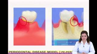 NISSIN PERIODONTAL DISEASE MODEL PEPER010 [upl. by Sybille]