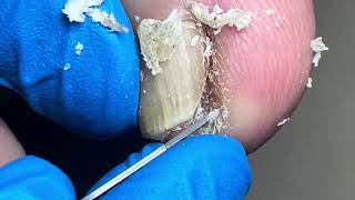 Sharp ingrown toenails trimmed and pulled out smoothly【Foot Scalpel】 [upl. by Elocyn637]