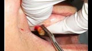 odf  Les extractions des dents permanentes en ODF [upl. by Ahtael152]