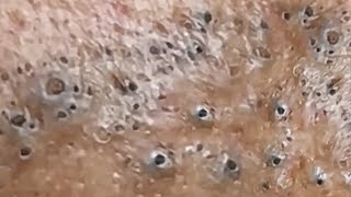 Blackheads amp Whiteheads Satisfying Removal 0048 [upl. by Kudva842]