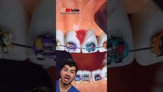 Braces Flossing Hack [upl. by Robison466]