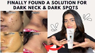 Dark neck amp Hyperpigmentation treatment  Acanthosis Nigricans treatment [upl. by Henryetta]