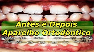 Aparelho Ortodontico Antes e Depois  Dentes Separados [upl. by Lytton45]