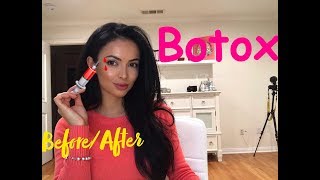 I tried Botox for the first time for Brow Lift and  Botox injection Before and after  By Sarv [upl. by Edd]