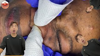 The MOST TERRIFYING Acne Squeezing Videos Youve Ever Seen 6 [upl. by Grindle]