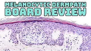 Melanocytic Dermpath Board Review melanoma blue nevus other nevi amp mimics pathology dermatology [upl. by Pengelly273]