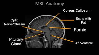 Normal Brain MRI Anatomy  Neuroradiology Made simple [upl. by Benedicta833]