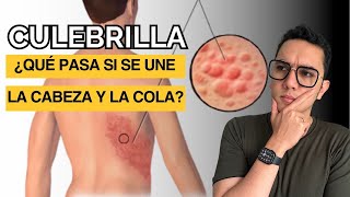 Culebrilla ¿Qué sucede si se une la cabeza con la cola Herpes zoster  Dr William Guerrero [upl. by Larcher]