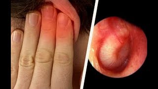 Infections aux oreilles  comment les soigner [upl. by Trillbee]