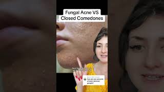 Fungal Acne VS Closed Comedones shorts acne [upl. by Aihsiyt]