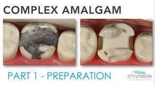 Complex Amalgam Preparation  Part 1 [upl. by Eiaj]