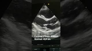 Coronary sinus dilation echocardiography science echocardiographer [upl. by Hardej491]