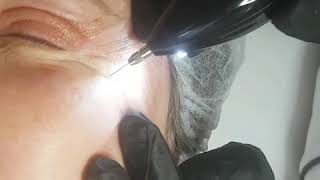 Phiion eyelid lifting treatment [upl. by Tobiah]