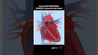 How Atrial Fibrillation AfibAF Occurs in the Heart [upl. by Walley]