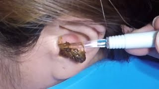 The Most Massive Earwax Removed in One Scoop [upl. by Enyaj946]