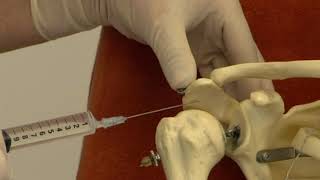 Injection for subacromial bursitis in the shoulder [upl. by Ernie653]