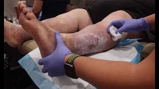 Wound Care Episode 9 Patient w Venous Ulcer amp Lymphedema treated by Dr Loan Lam at Hyper Healing [upl. by Aissat]