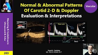 Normal amp Abnormal Patterns of Carotid Doppler [upl. by Dygert]