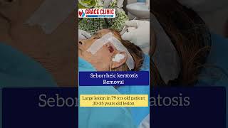 Seborrheic keratosis removal  Grace clinic Dehradun  Dr Naziya khatun [upl. by Atnima]