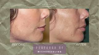 Profound RF Microneedling Benefits [upl. by Lally]