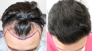 FUE Hair Transplant 2305 Grafts NW III A by Dr Juan Couto  FUEXPERT CLINIC Madrid Spain [upl. by Faxon]