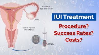 IUI Treatment Procedure Costs Success Rates [upl. by Arbua]