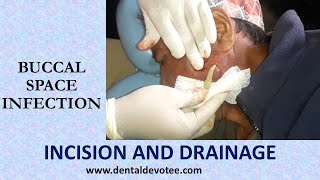 Incision and Drainage of Buccal space infection by Dr Raman Dhungel [upl. by Hsital917]