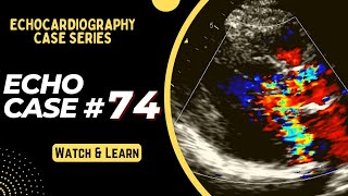 ECHO CASE 74  Echocardiography spot diagnosis Series  Echocardiogram Reporting  Echo Board [upl. by Ettenhoj540]