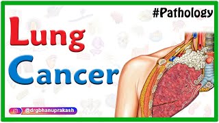 Lung Cancer  Pathology  Squamous cell carcinoma usmle neetpg fmge mbbs [upl. by Norling603]