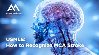 USMLE MCA STROKE how to recognize [upl. by Nanyk]