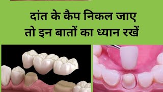 दांत के कैप निकल जाएDental cap dislodgedTooth cap removalदांत का कैप निकल गईbroken dental cap [upl. by Beaston]