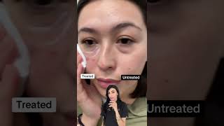 Remove Dark Circles Using EYEGLOW dermatologist [upl. by Weitman]