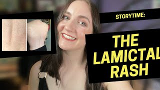 hell on earth the lamictal rash STORYTIME [upl. by Rigdon]